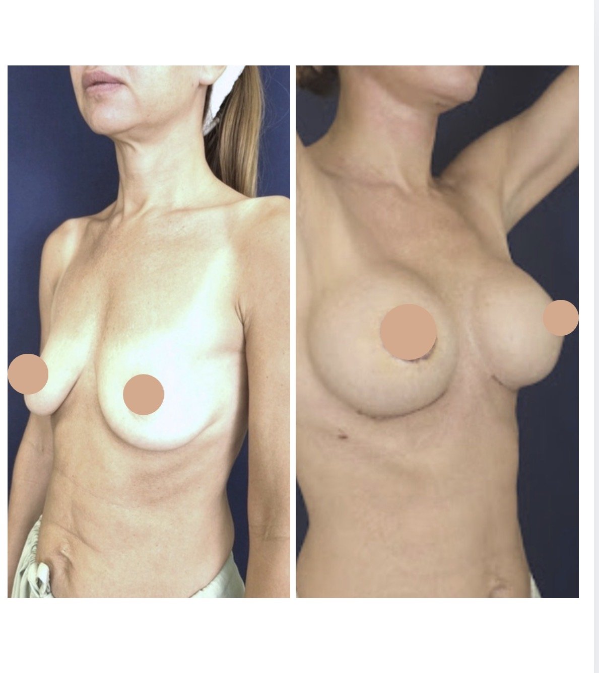 Comparison of a woman before and after breast augmentation surgery, with visible changes in breast size and shape.