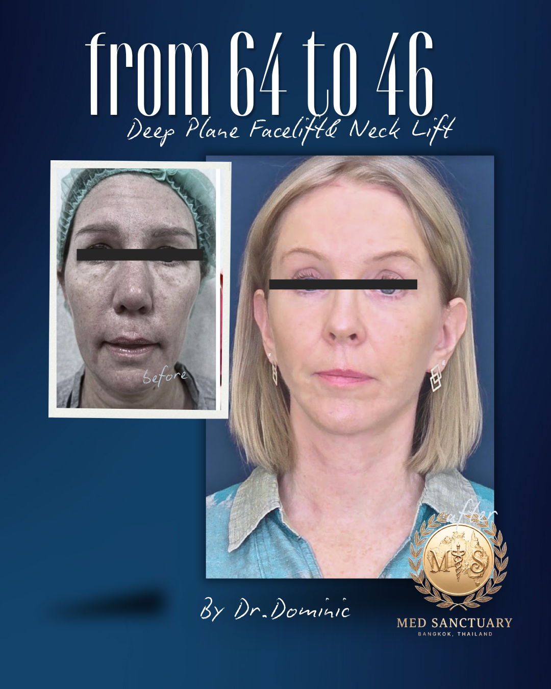Before and after photos showing a woman's face, demonstrating the results of a deep plane facelift and neck lift from age 64 to 46, performed by Dr. Dominic at Med Sanctuary in Bangkok, Thailand.