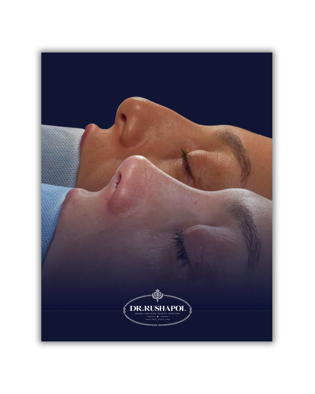 Close-up of two people lying down with eyes closed, showing their noses and partial faces, with a dark background. Logo at the bottom reads 'Dr. Rushapol, Board Certified Plastic Surgeon, Thailand, Since 1998.'