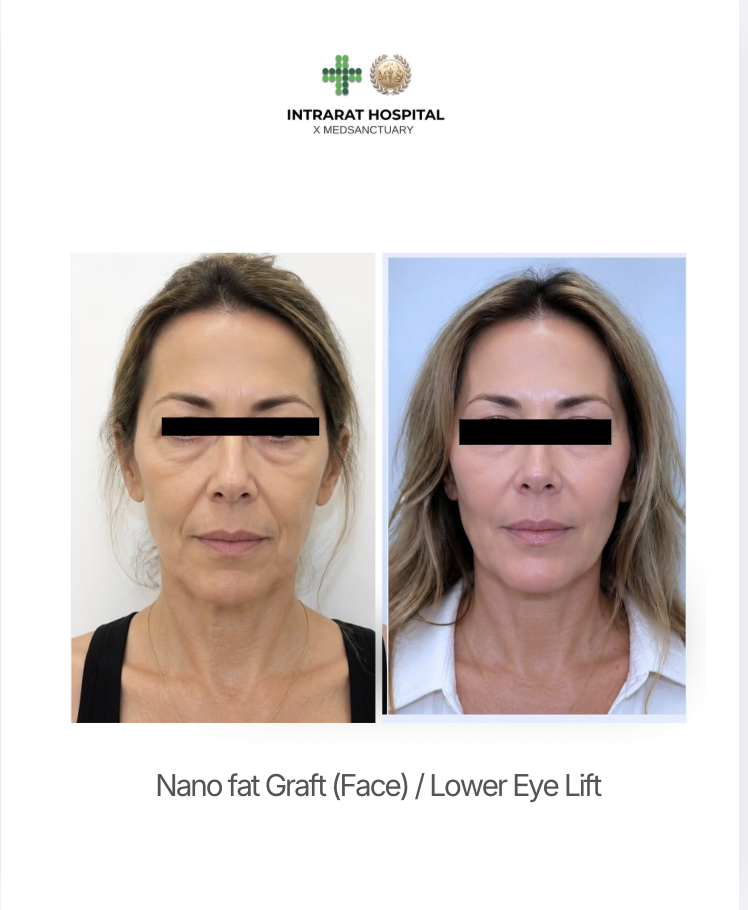 Side-by-side comparison of a woman before and after a nanofat face graft and lower eye lift procedure, showing reduced under-eye bags and smoother facial skin at the clinic.