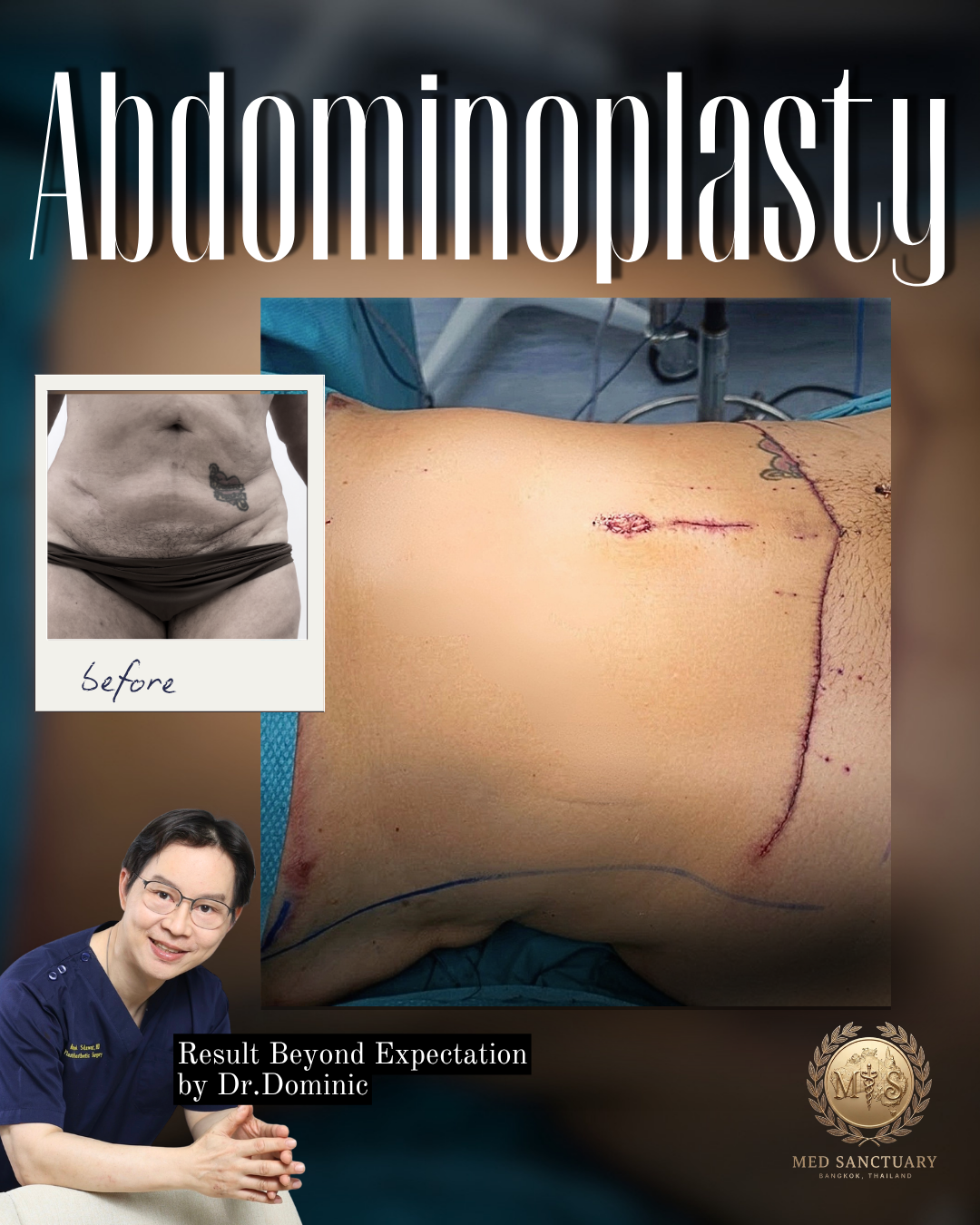 Promotional image for abdominoplasty featuring before and after photos, surgical scars, and a doctor. The main photo shows a patient's abdomen post-surgery with visible scars. The inset photo shows a patient’s bare abdomen before surgery. The text re