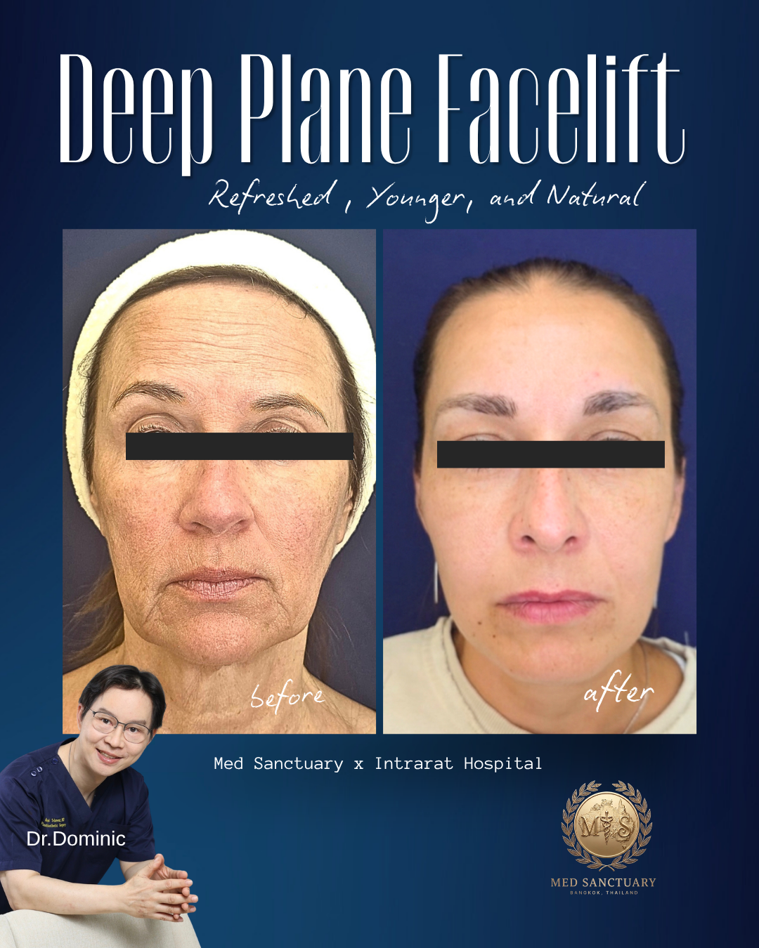 A side-by-side before and after photo of a woman showing facial improvements from a deep plane facelift. The 'before' image shows aged skin with wrinkles, while the 'after' image shows smoother, younger-looking skin. The poster includes the text 'Dee