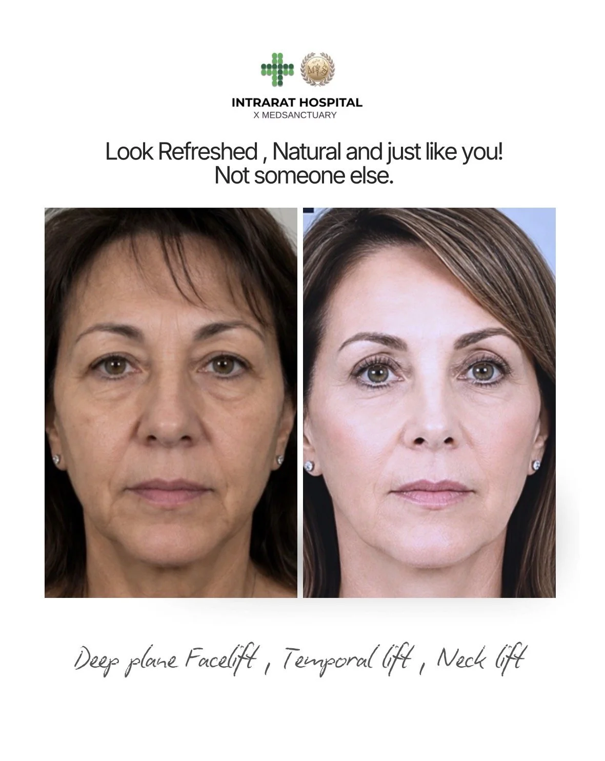 Side-by-side comparison of a woman before and after facial treatments, showing improvement in skin texture and lifting, labeled with 'Deep plane Facelift, Temporal lift, Neck lift' at the bottom.