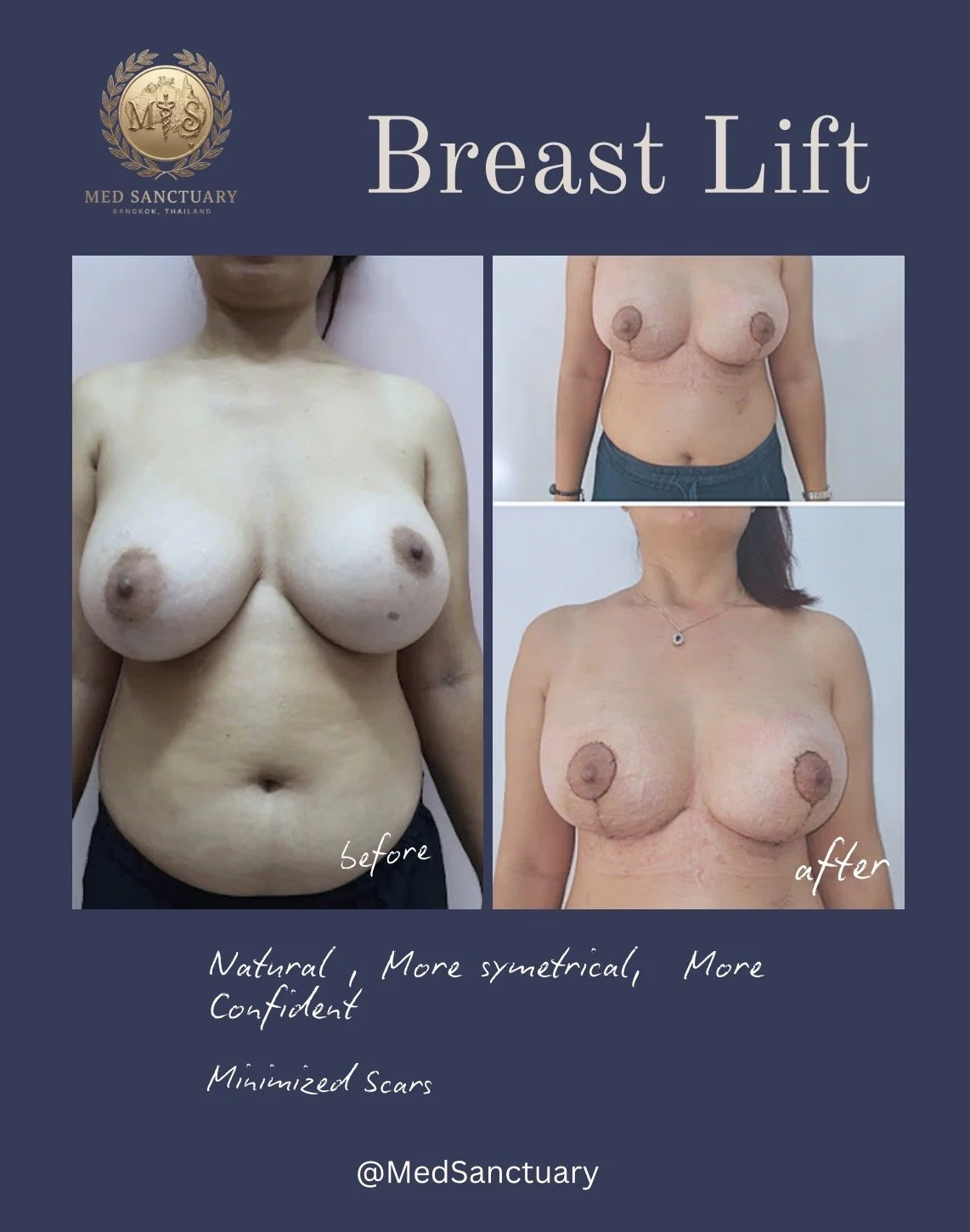 Comparison of before and after breast lift surgery, showing a woman with larger, sagging breasts before the procedure and smaller, more symmetrical breasts after. The image highlights minimized scars and increased confidence.