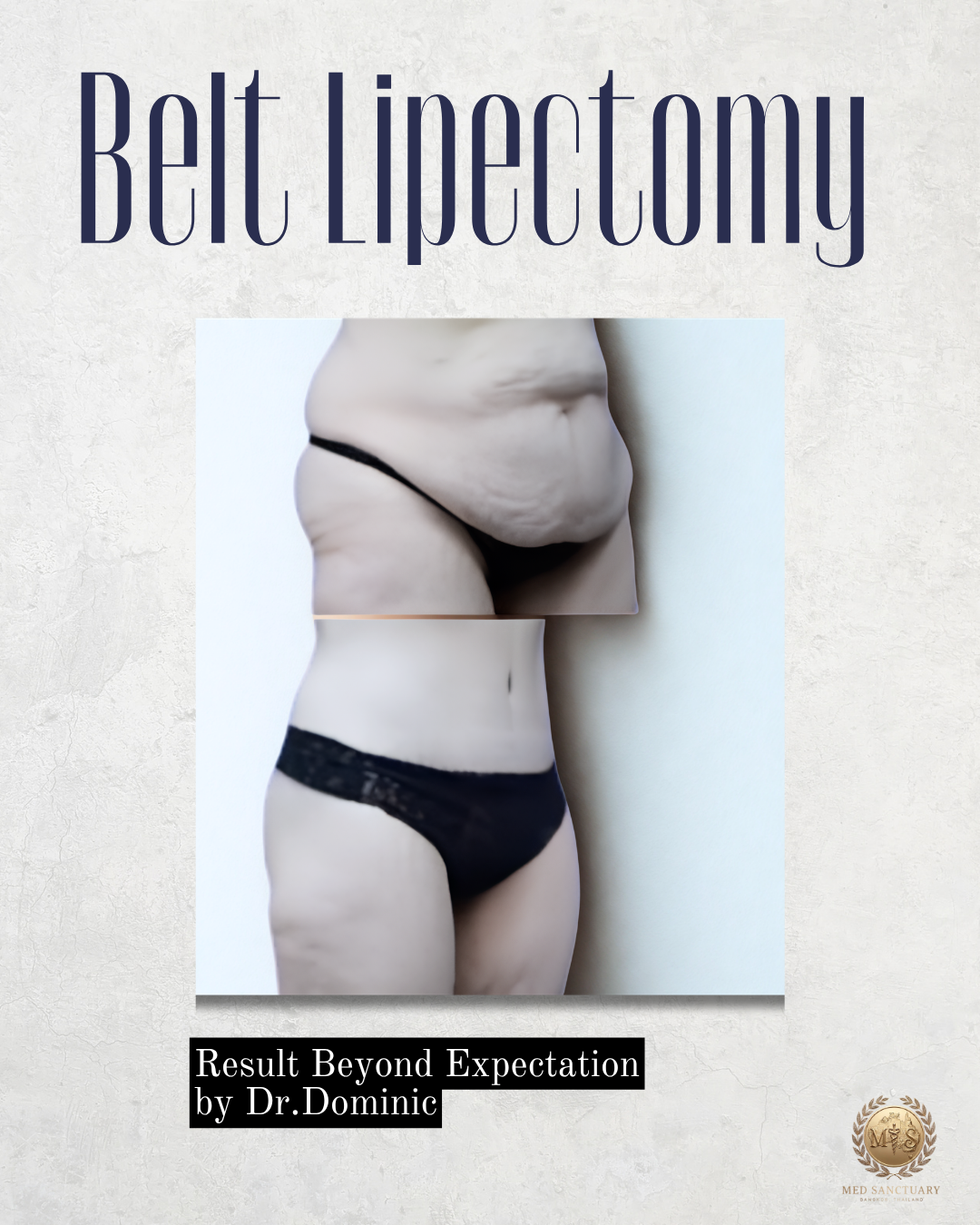 Book cover titled 'Belt Lipoctomy' with an image of a woman's midsection, showing excess skin before and after a procedure, and a small logo at the bottom right corner. Subtitle reads 'Result Beyond Expectation by Dr. Dominic'.
