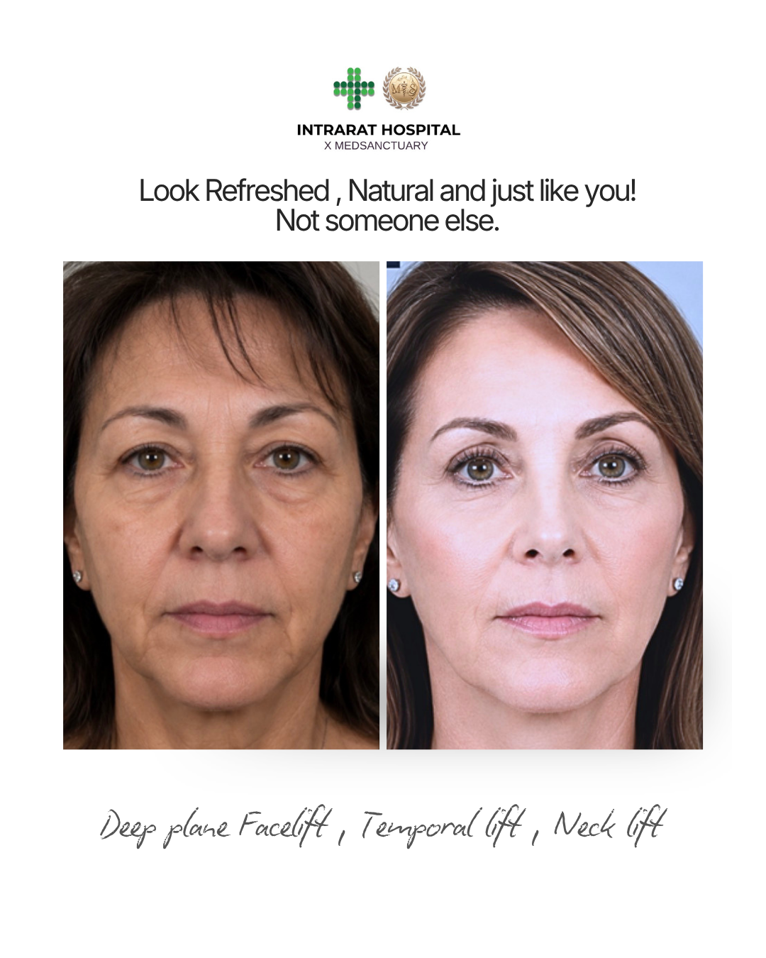 Before and after images of a woman showing facial improvements. The before photo shows signs of aging, dark circles, and sagging skin. The after photo shows a refreshed, youthful appearance with smooth skin and a tightened jawline. Text promotes deep