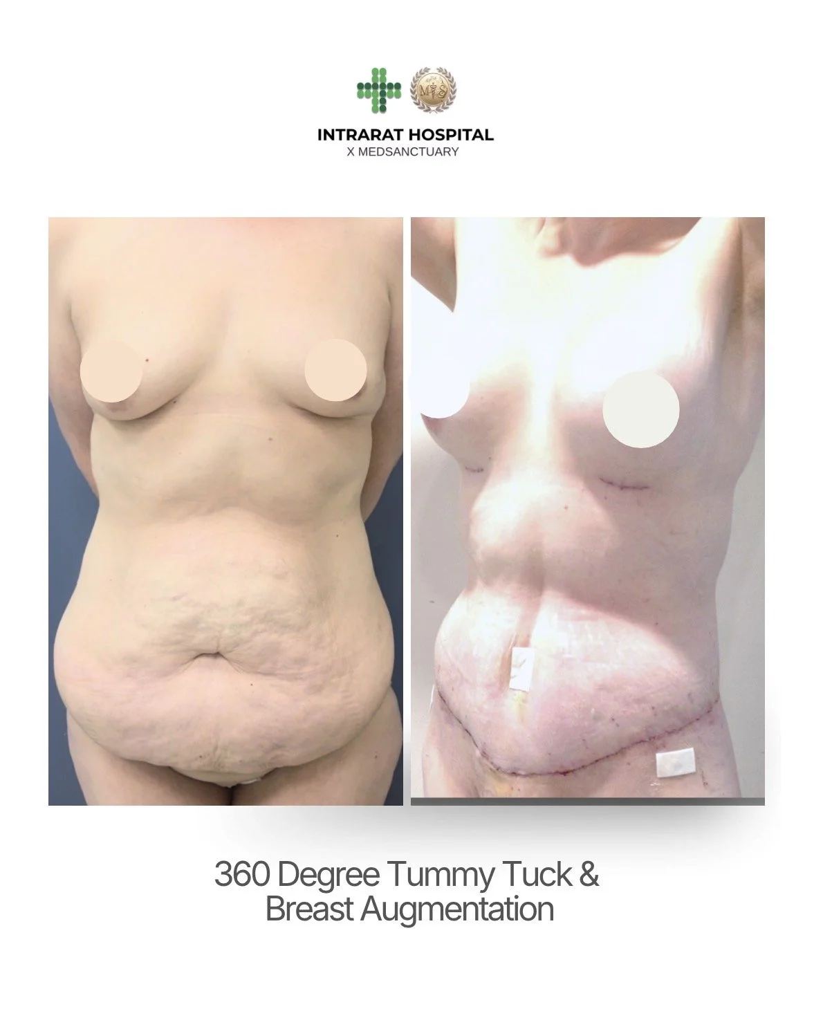 Before and after images of a woman's torso, showing significant weight loss and surgical scars following stomach tuck and breast augmentation procedures.