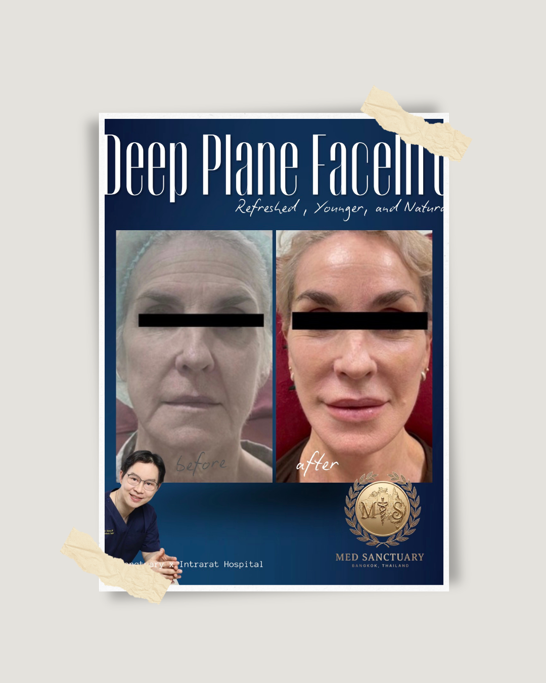 Before and after photos of a woman's face showing results from deep plane facelift, with text 'Deep Plane Facelift, Refreshed, Younger, and Natural,' and logos for Med Sanctuary in Bangkok, Thailand.