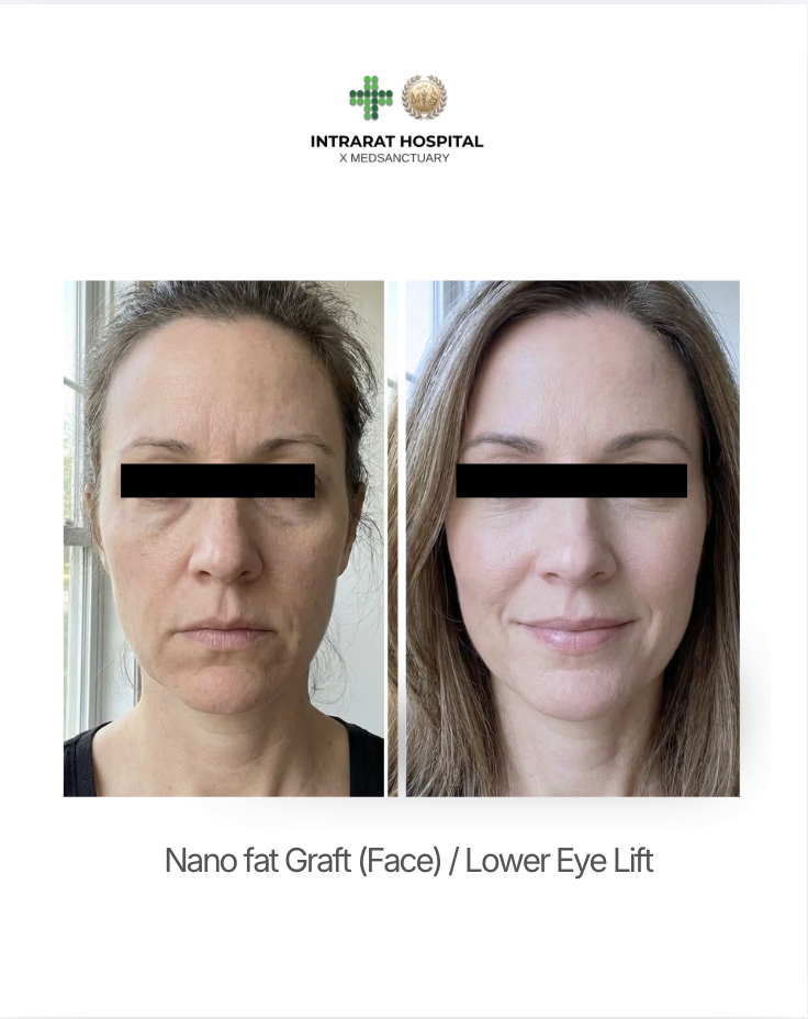Before and after photos showing the results of a nano fat graft face and lower eye lift procedure, with improved skin and reduced signs of aging.