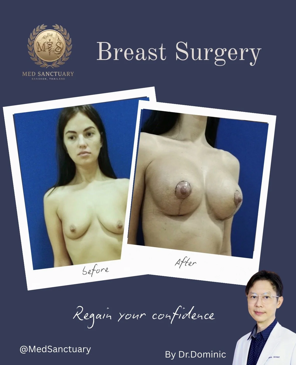 A promotional poster for breast surgery by Dr. Dominic at Med Sanctuary Bangkok, Thailand. It shows before and after photos of a woman who underwent breast augmentation, with the before photo on the left showing her natural breasts and the after phot