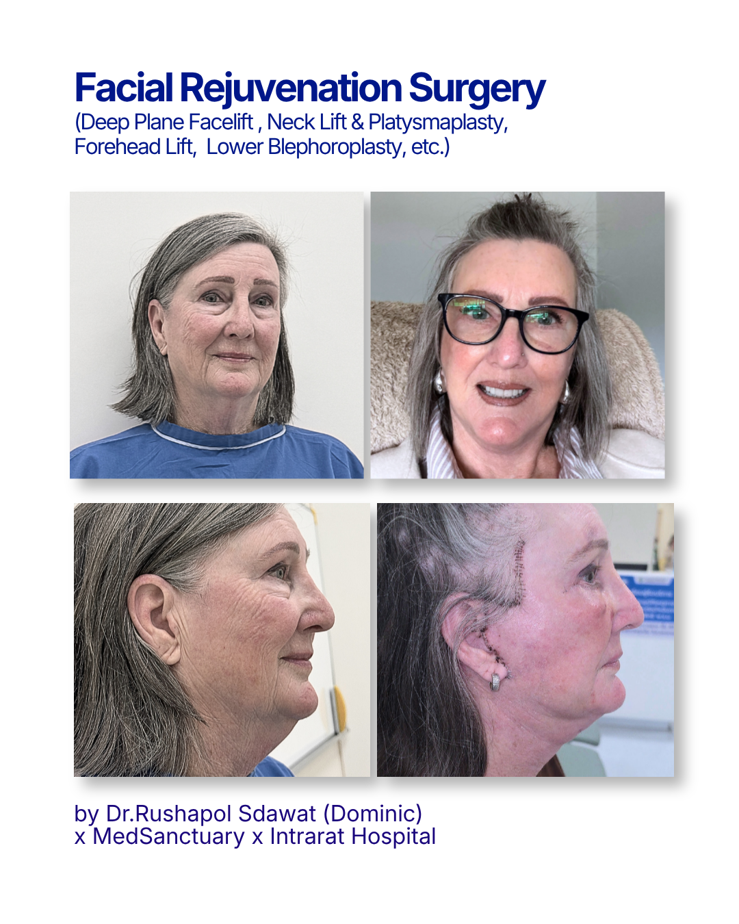 Poster showing before and after photos of a woman who underwent facial rejuvenation surgery, including deep facelift and neck lift, with images from different angles and a doctor’s note at the bottom.