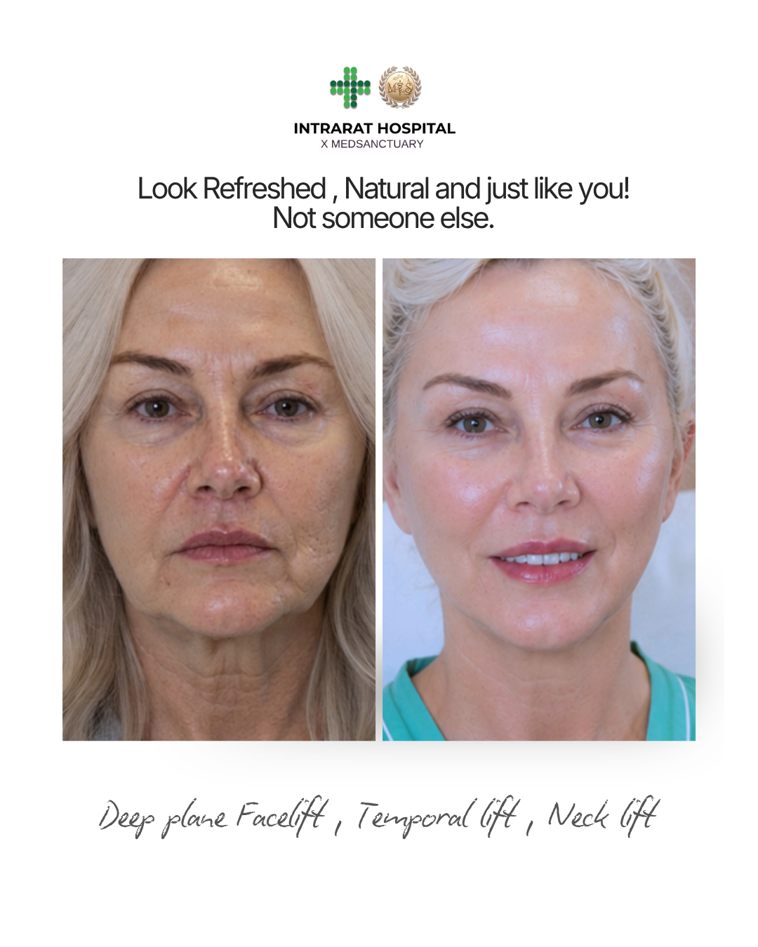 Side-by-side comparison of a woman's face before and after cosmetic procedures, showing improved skin texture and youthful appearance.