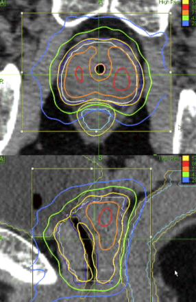 Quantifying The Role of Urethra Sparing in Prostate SBRT Treatments