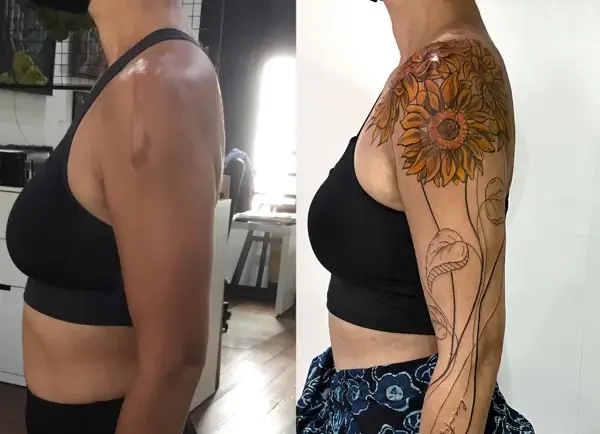 Tattoos über Narben.. was ist möglich?