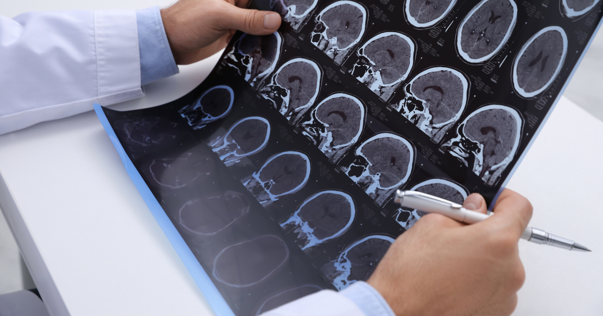 A doctor examining brain MRI scans on film sheet, with a pen in hand