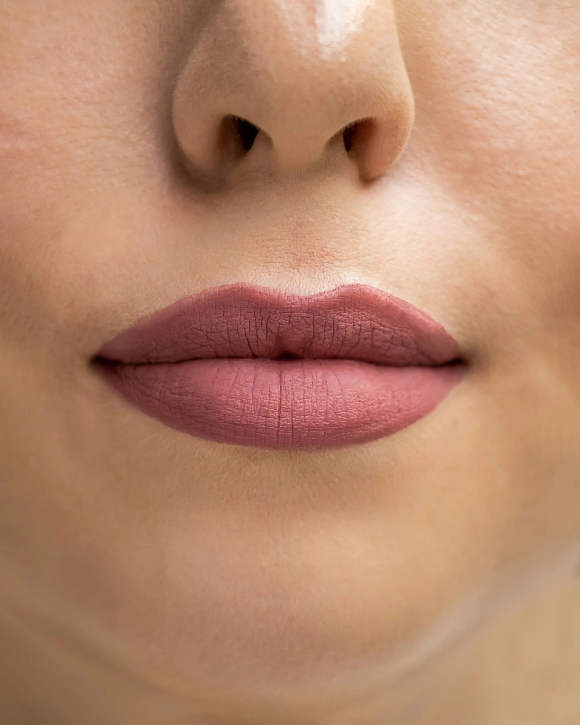 DERMAL FILLERS