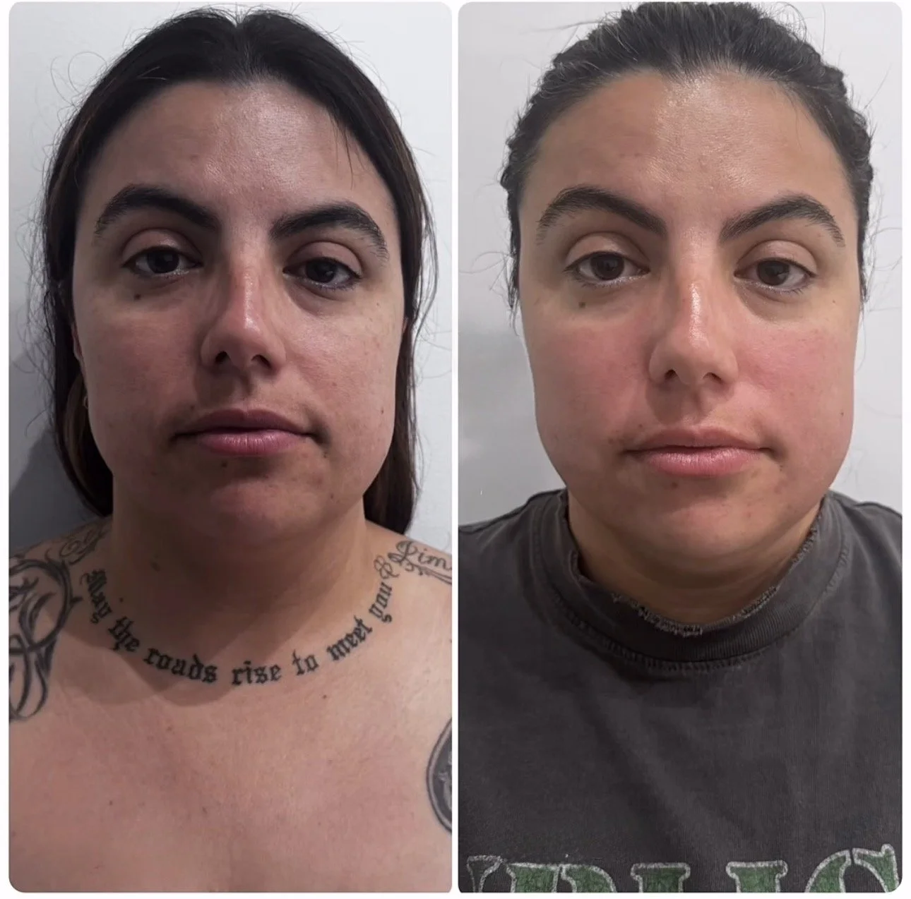 MRT BEFORE & AFTER