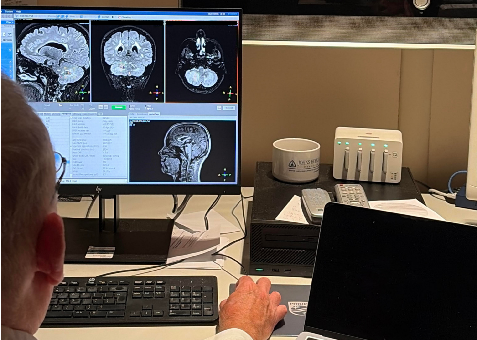 A doctor reviewing an LBSL patient's brain scan