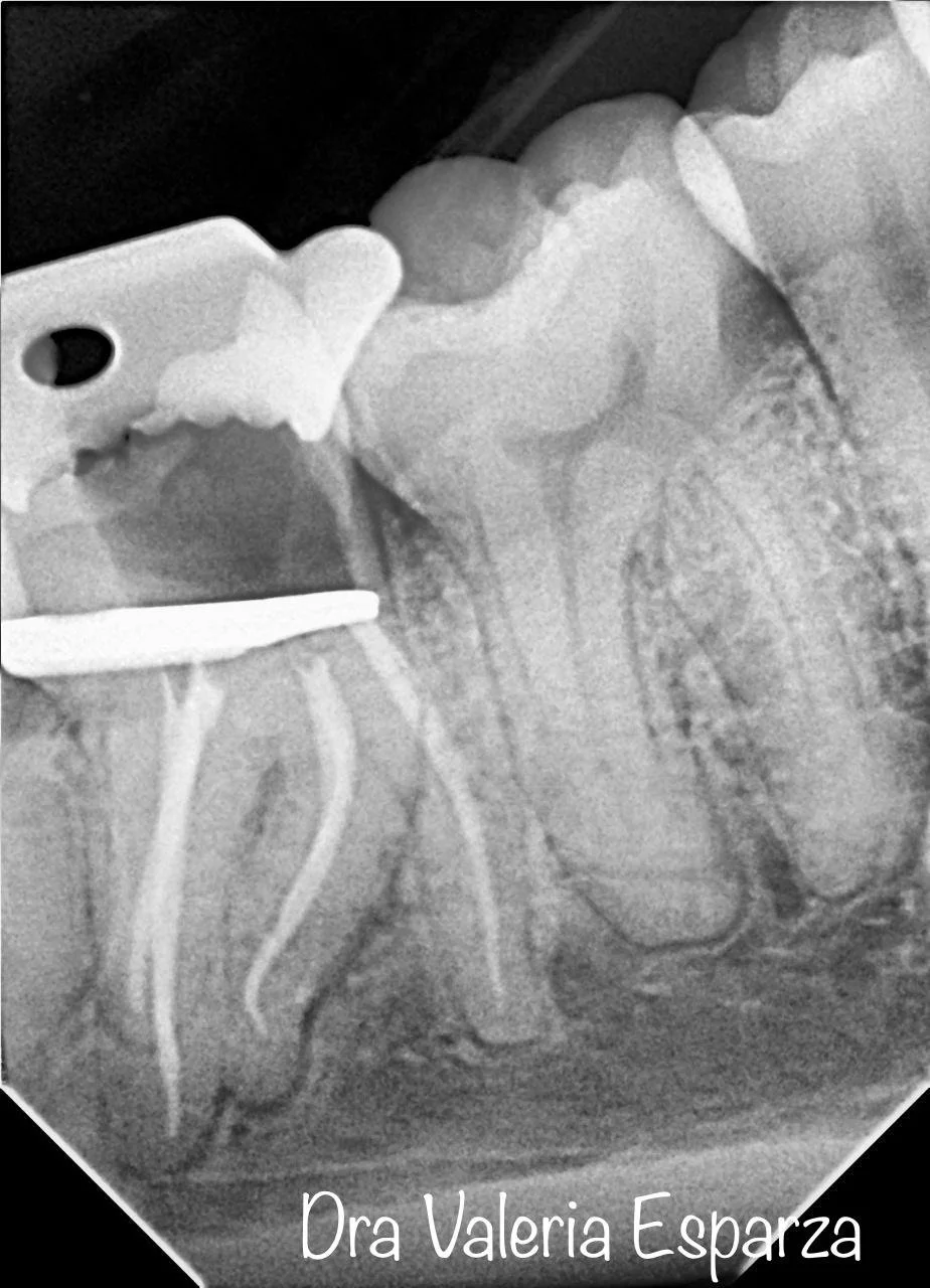ROOT CANAL (ENDODONCIA)