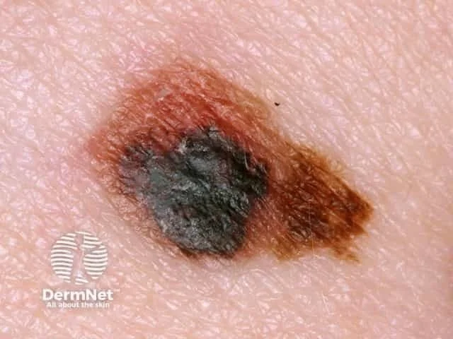Close-up of a mole or skin lesion with black and brown coloring on skin.