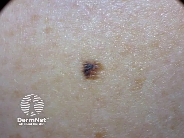 Close-up of a mole on human skin with the DermNet logo in the bottom left corner.