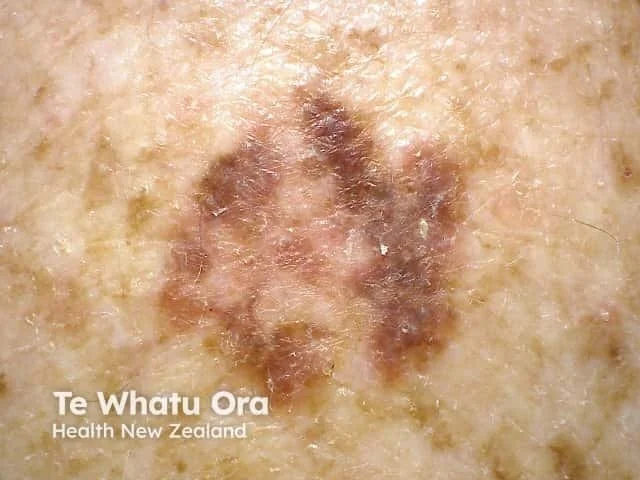 Close-up image of a skin lesion with a dark, irregularly-shaped mole on light skin, with text overlay reading 'Te Whatu Ora, Health New Zealand.'