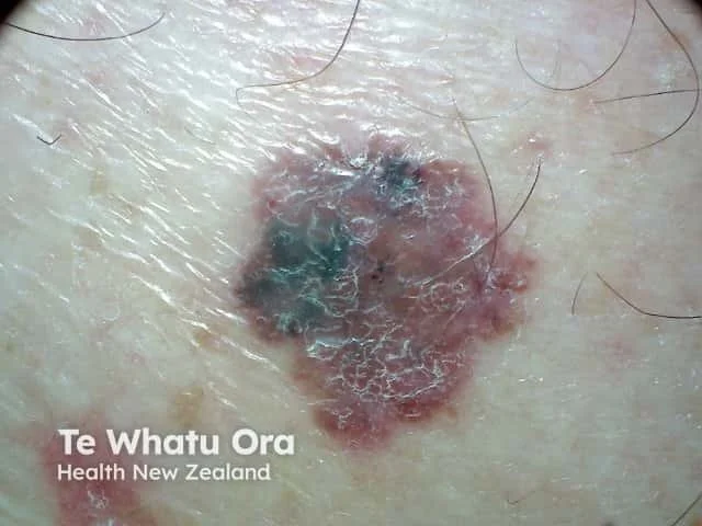 Close-up of a skin mole with dark pigmentation and irregular borders.