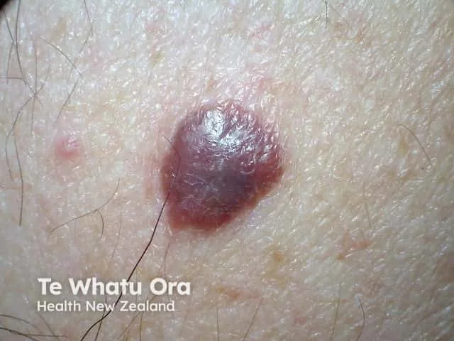 Close-up photo of a mole or skin growth on human skin with hair follicles visible.