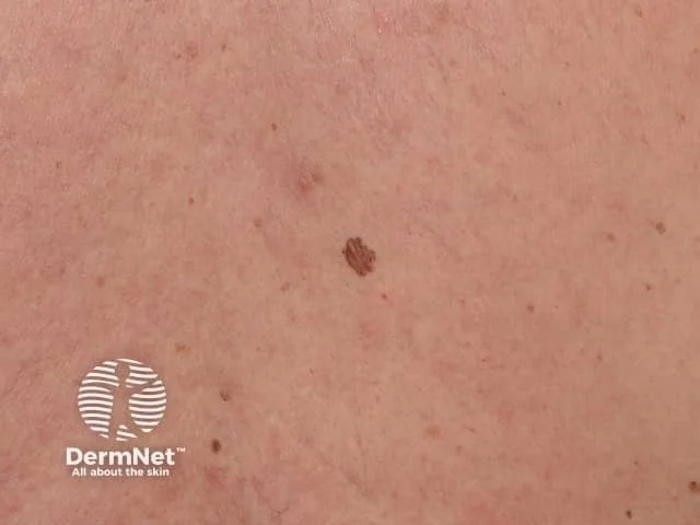 Close-up of skin with a small mole and a DermNet logo in the lower left corner.