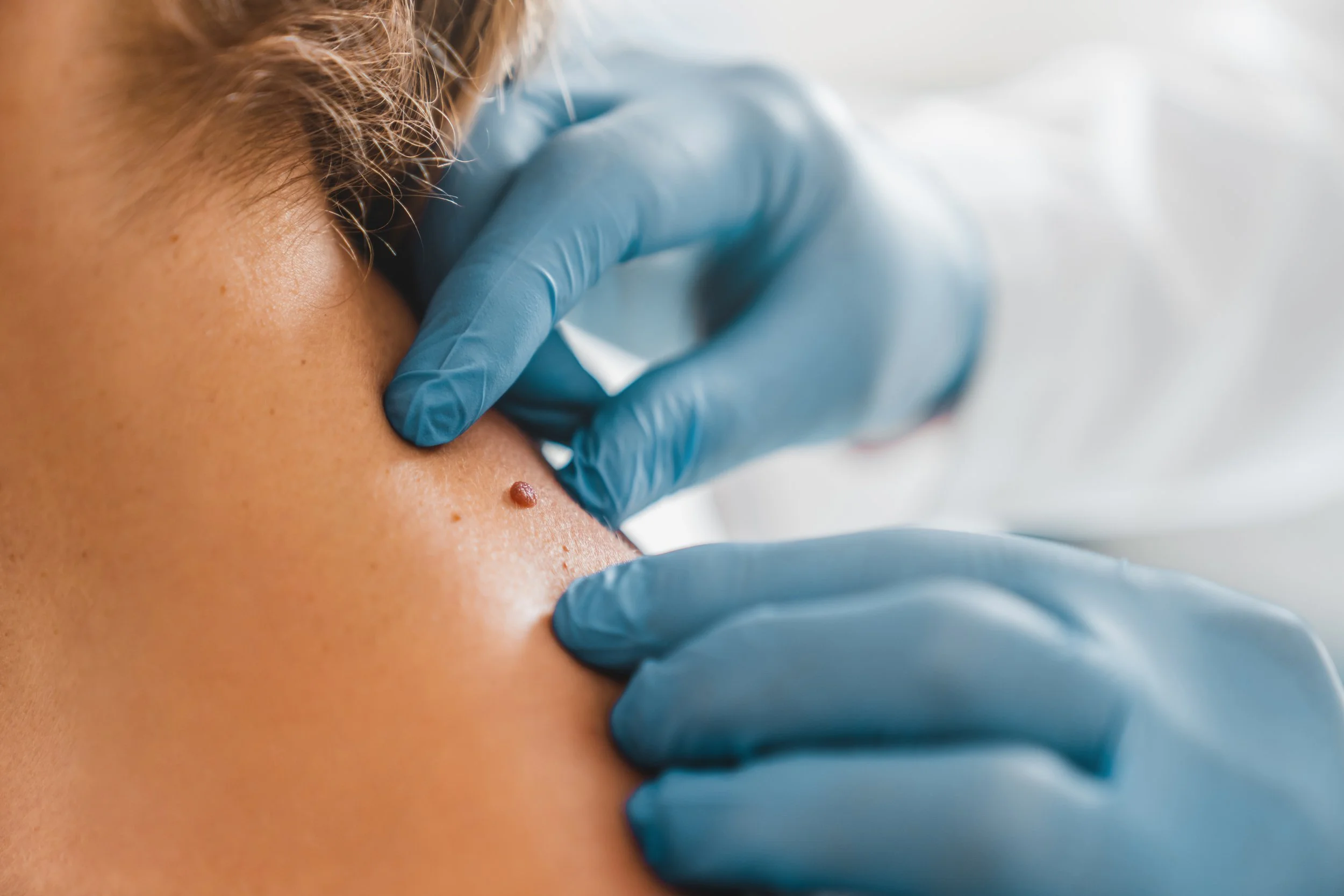 A healthcare professional wearing blue gloves is removing a mole or skin growth from a person's skin.