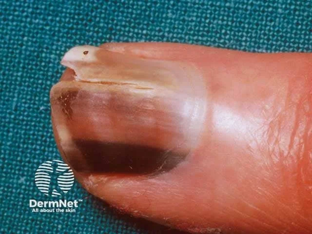 Close-up of an adult toenail with dark discoloration and thickening, possibly indicating a fungal infection, on a blue textured background with 'DermaNet' logo and slogan.