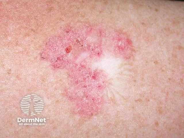 Close-up of irritated, red, and inflamed skin with a patch of damaged skin on the surface, possibly a skin condition.