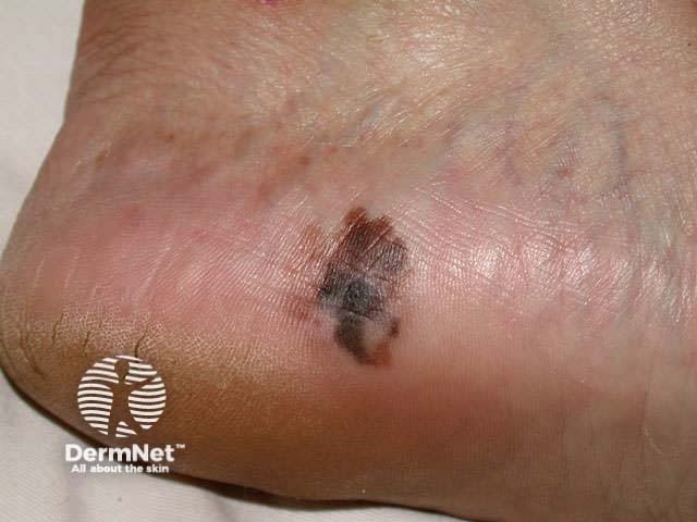 Close-up of a skin lesion with a dark, irregular spot on the heel of a foot, showing signs of possible skin cancer or mole.