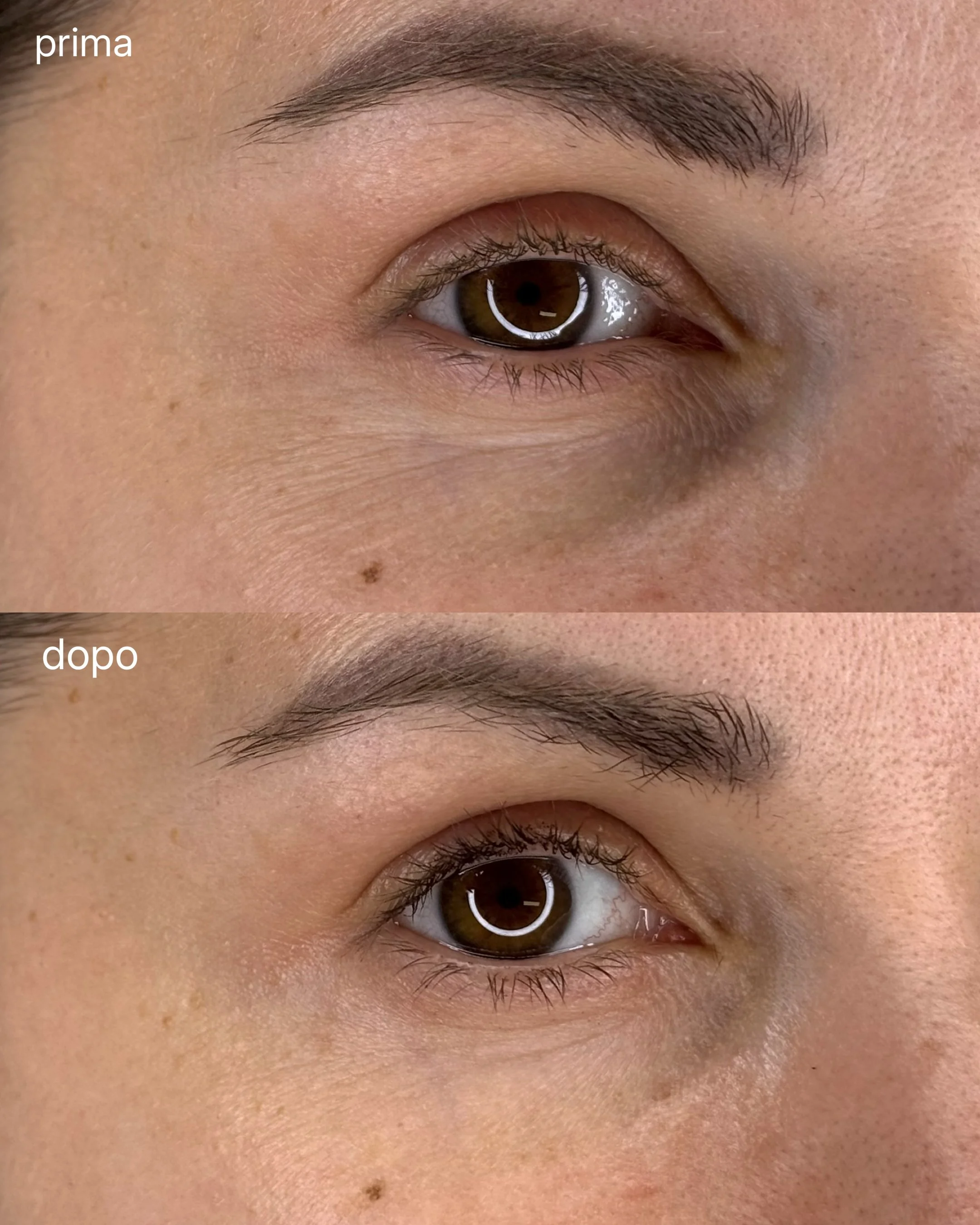 Prima e dopo contorno occhi dopo il trattamento di Peeling occhi e veicolazione fiala specifica per trattamento occhi: rughe distese e attenuate, colore uniforme e luminoso