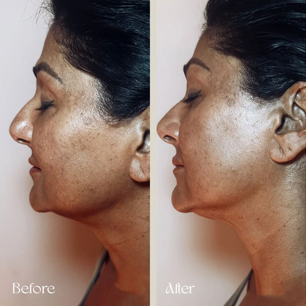 Side-by-side comparison of a woman's face showing skin improvement, labeled 'Before' and 'After'.