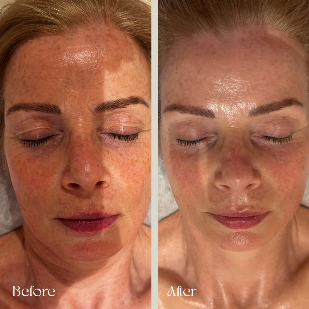 Comparison of a woman's face before and after skincare treatment, showing reduced redness and pigmentation on the right side.