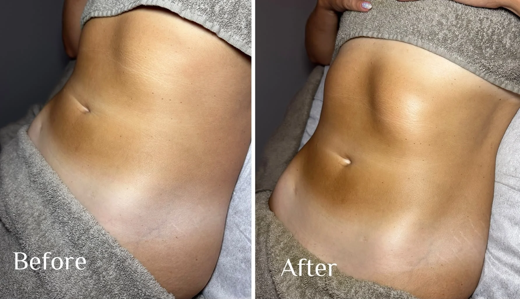 Side-by-side comparison of a person's toned abdomen, showing a 'Before' and 'After' image highlighting improvements lymphatic drainage.