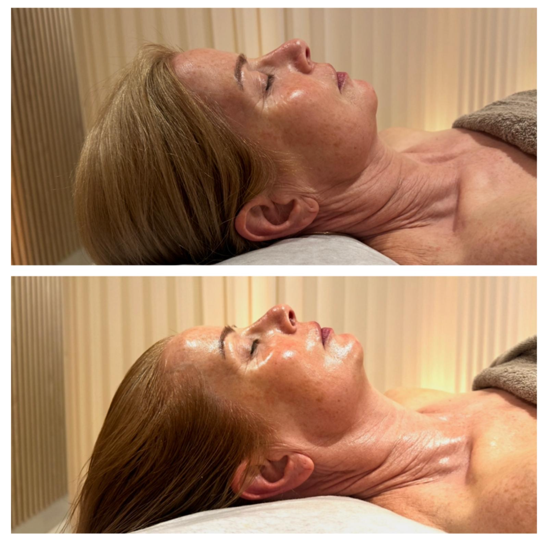 Before and after images of a woman receiving a facial treatment, showing skin improvements.