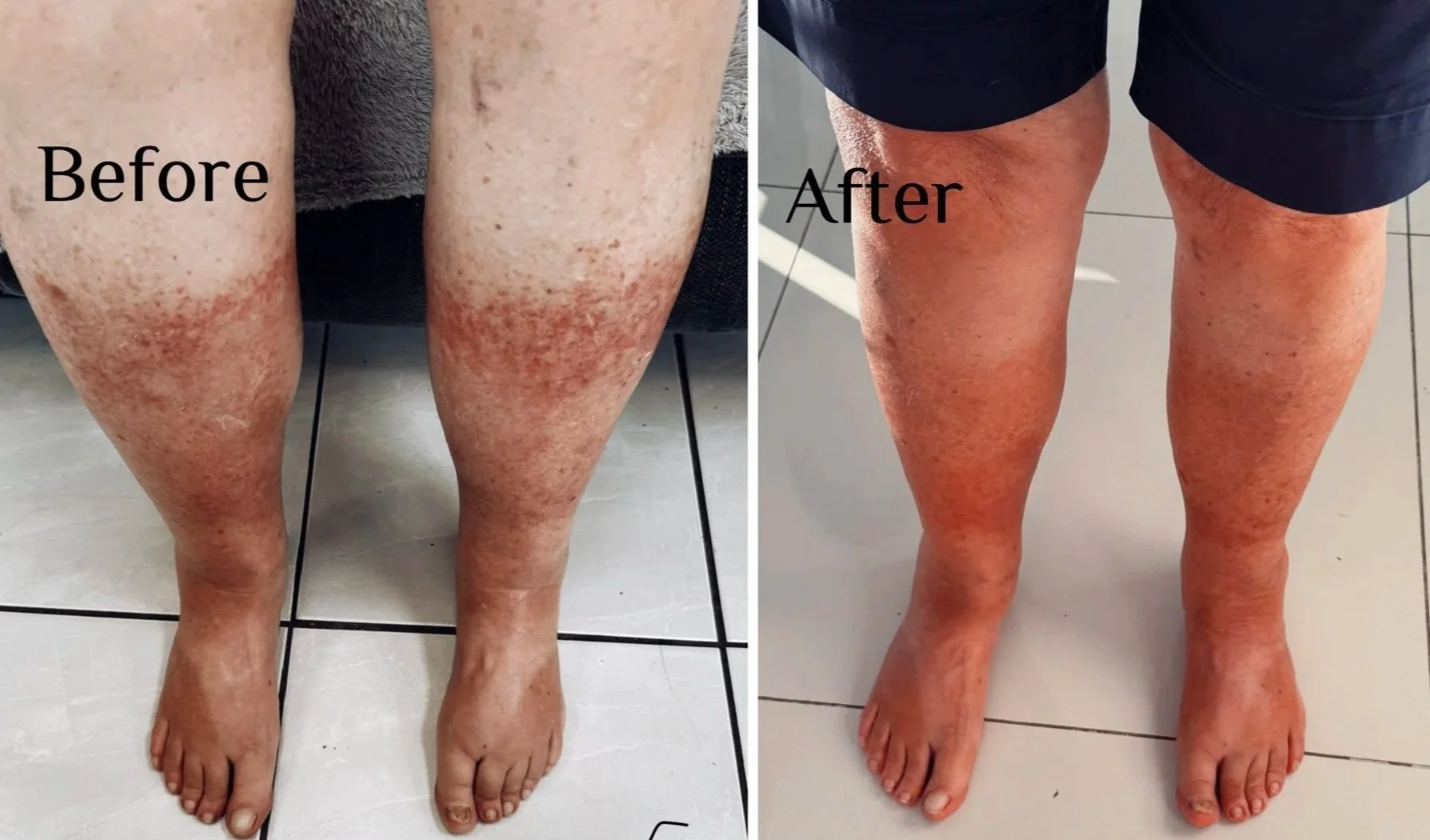 Side-by-side comparison of a person's legs before and after treatment, showing a reduction in skin redness and pigmentation on the legs.