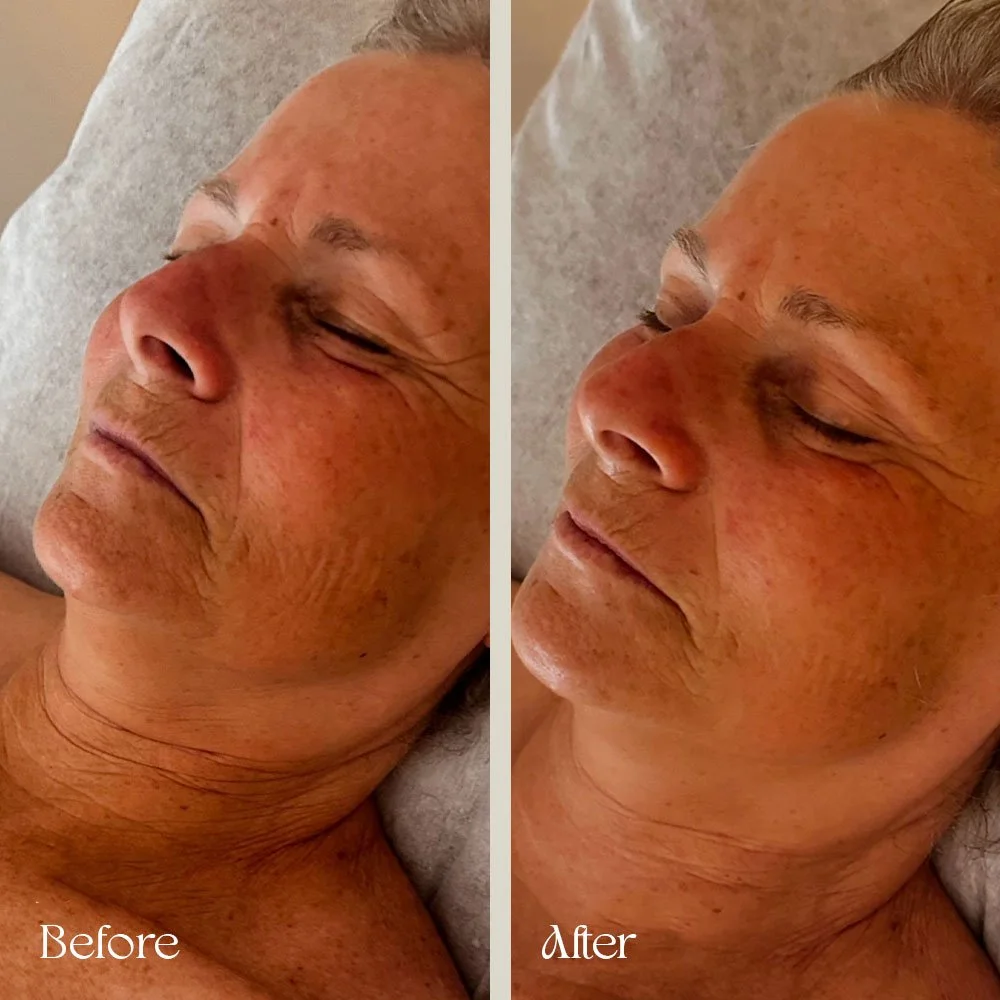 Comparison photo of an elderly woman showing a facial skin treatment. The left side labeled "Before" shows her with more wrinkles and uneven skin tone, while the right side labeled "After" shows smoother skin with fewer wrinkles.
