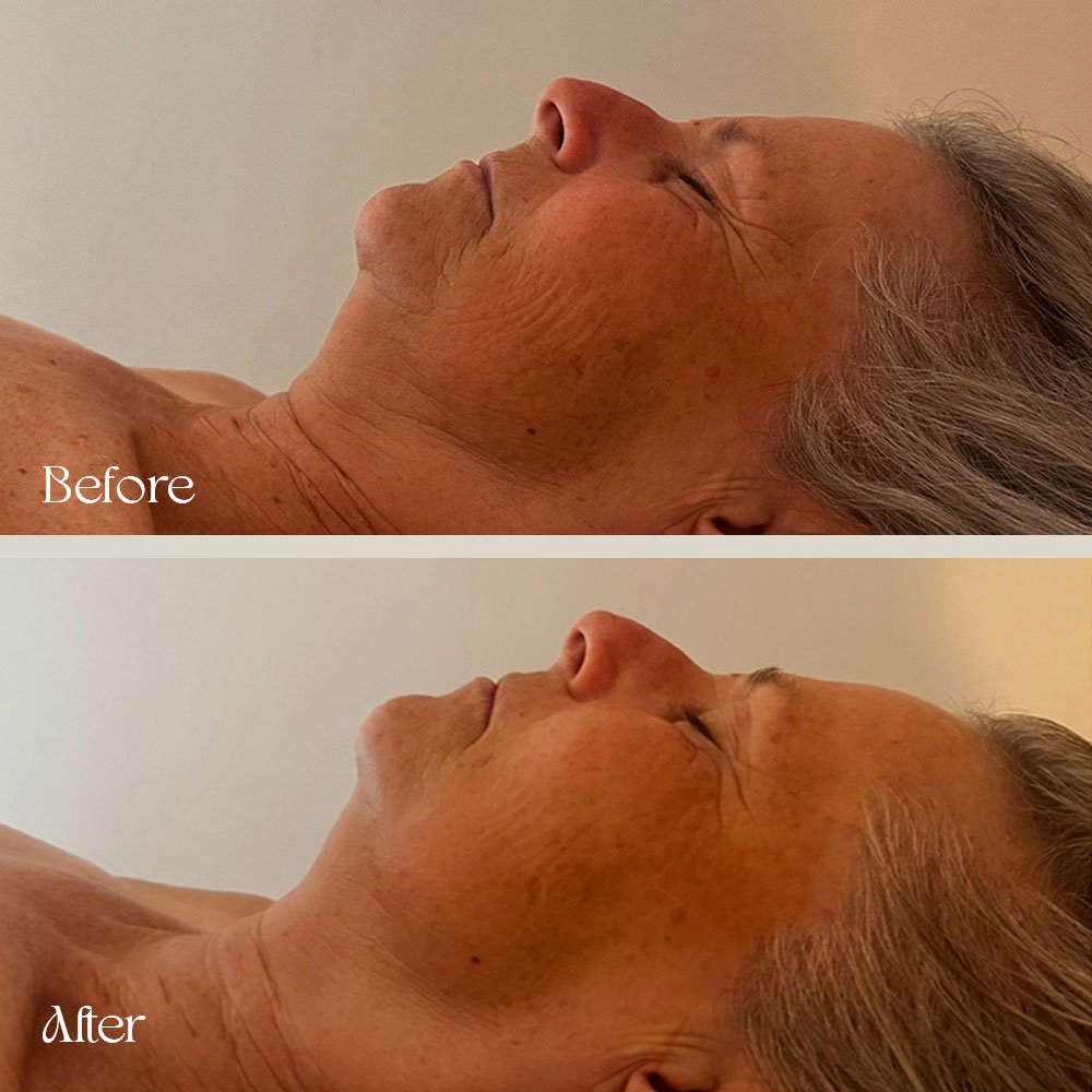 Side-by-side comparison of a woman's face showing a before and after of a skincare procedure focusing on the jawline and neck area, with a more defined jawline in the after image.