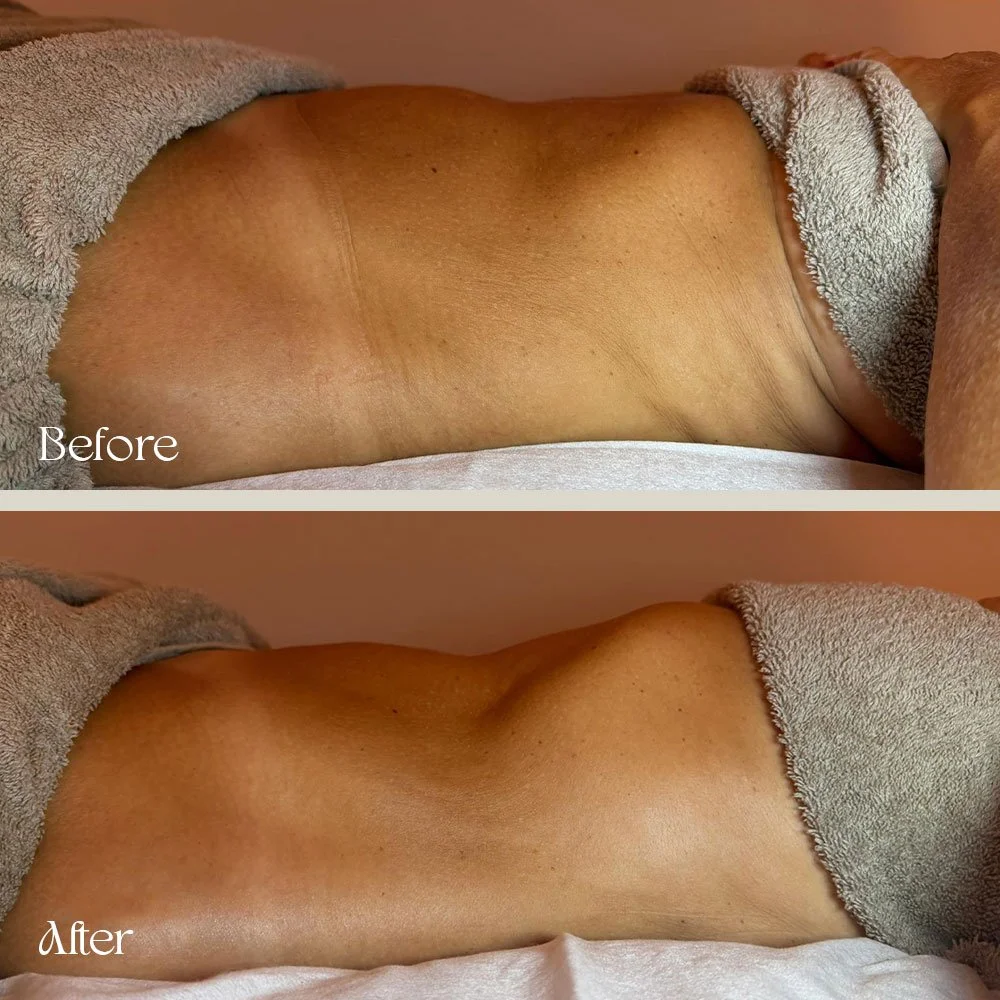 Comparison of a person's back before and after a treatment, showing reduced skin discoloration and improved skin appearance.