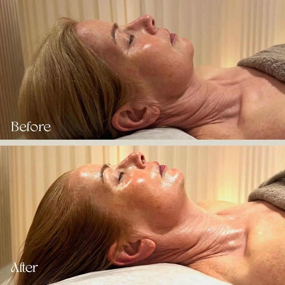 Side-by-side comparison of a woman lying down with her eyes closed, showing a 'Before' and 'After' treatment. The 'Before' image shows her skin with signs of aging and some wrinkles, while the 'After' image shows smoother, more youthful-looking skin 