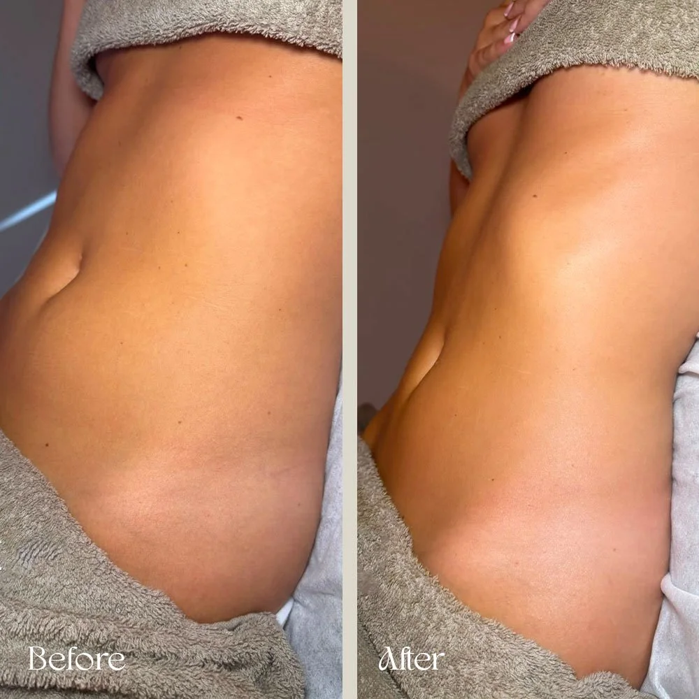 Side-by-side comparison of a woman's midsection showing a before and after of a lymphatic treatment, with the left labeled 'Before' and the right labeled 'After'.