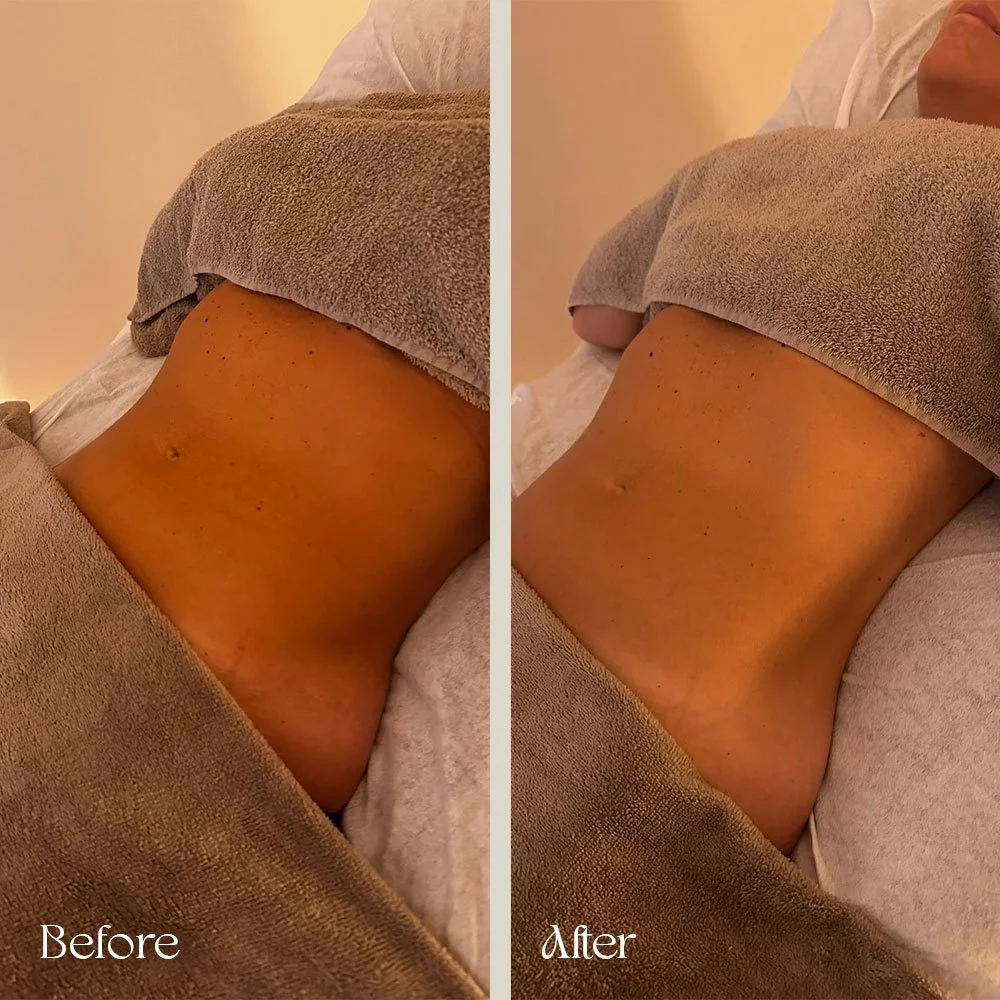 Side-by-side comparison of a person's abdomen before and after a treatment or procedure, showing a slight reduction in skin imperfections and improved skin tone.