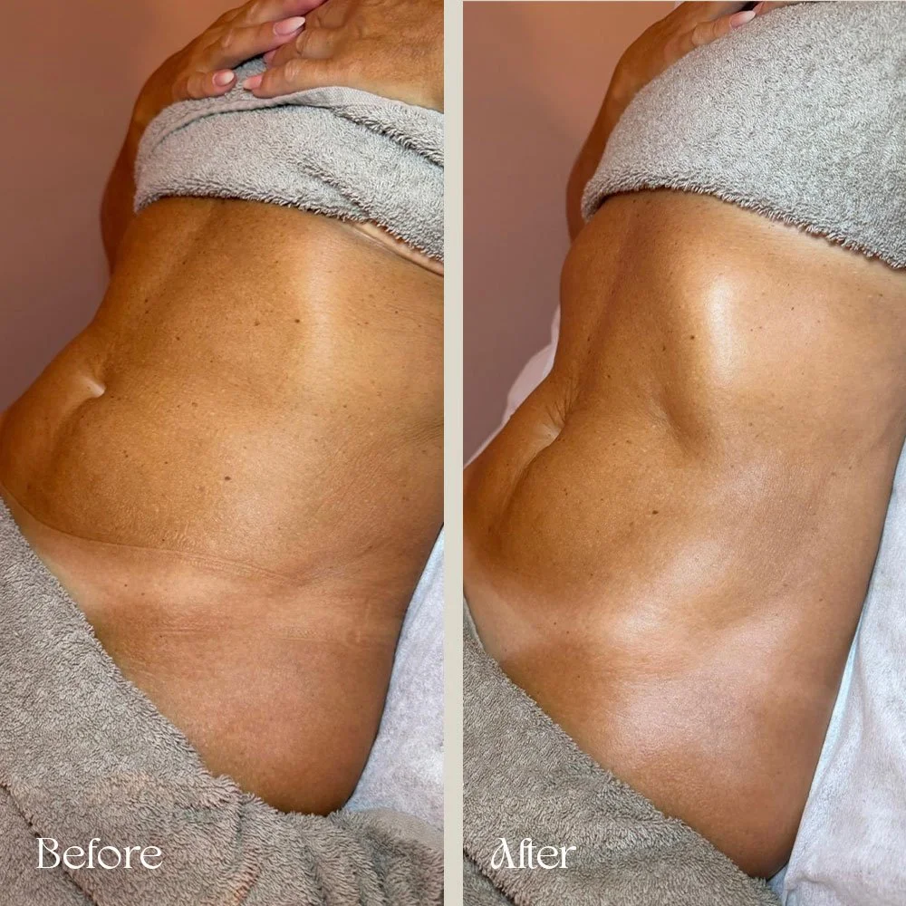 Comparison of a person's torso with a towel wrapped around the chest showing before and after images of lymphatic treatment, with smoother skin and less bloating in the after picture.