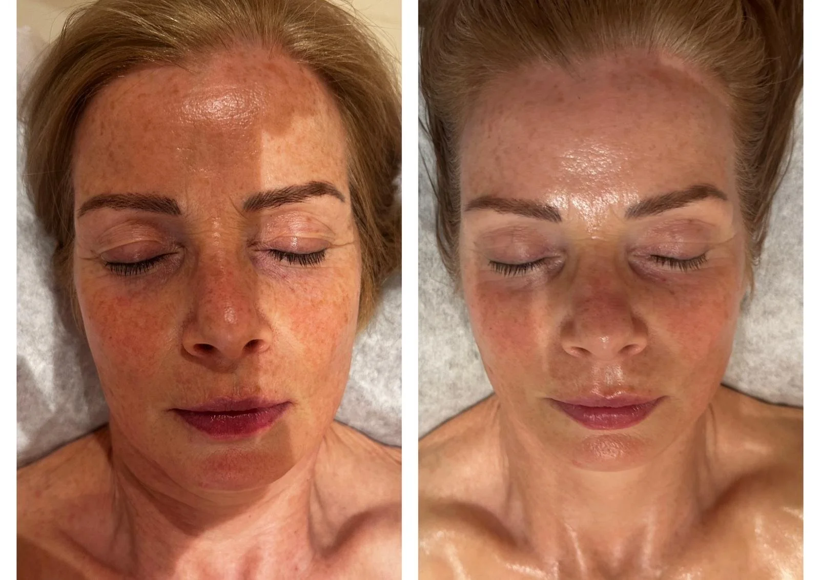 Side-by-side comparison of a woman's face with before and after skincare treatment, showing reduced redness, pigmentation, and improved skin texture and tone.