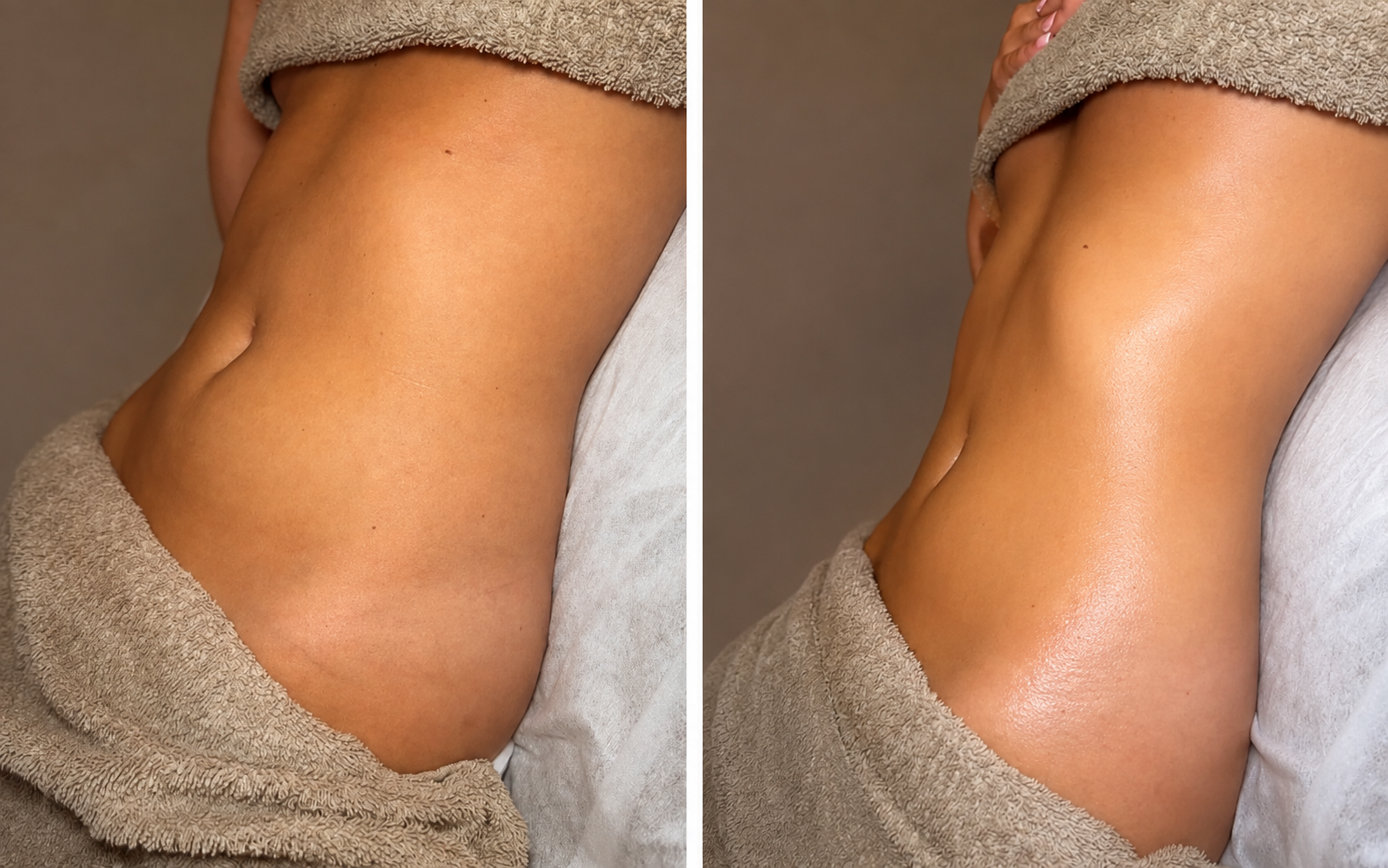 Side-by-side comparison of a woman's waist and abdomen before and after a lyphatic treatment, with smooth, glowing skin.