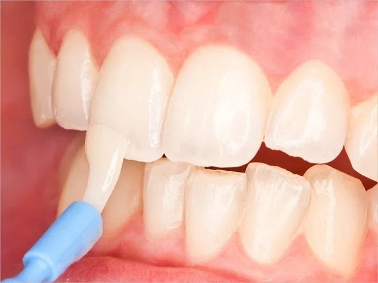 Close-up of a person's mouth showing teeth, with a dental instrument applying whitening gel or paint on the front teeth.