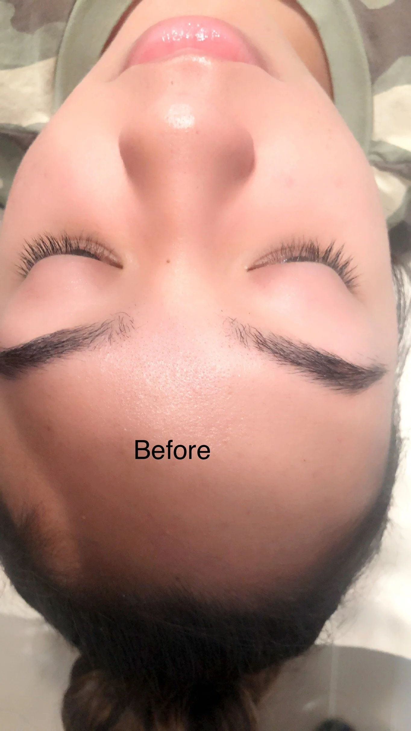 Close-up of a person's face lying upside down, showing forehead, eyebrows, closed eyes, and nose. The word 'Before' is written at the bottom.